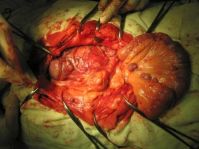 GIST опухоль (3) GIST опухоль (3)